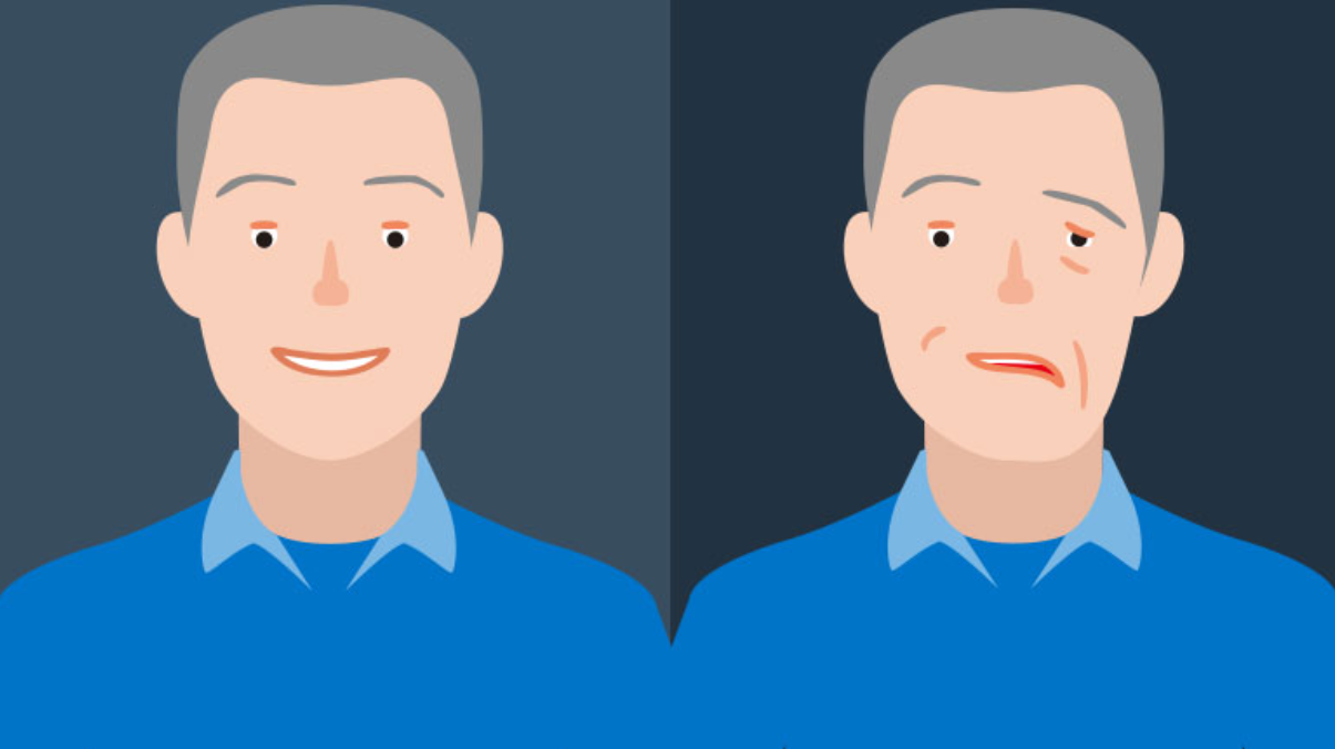 Bell's Palsy